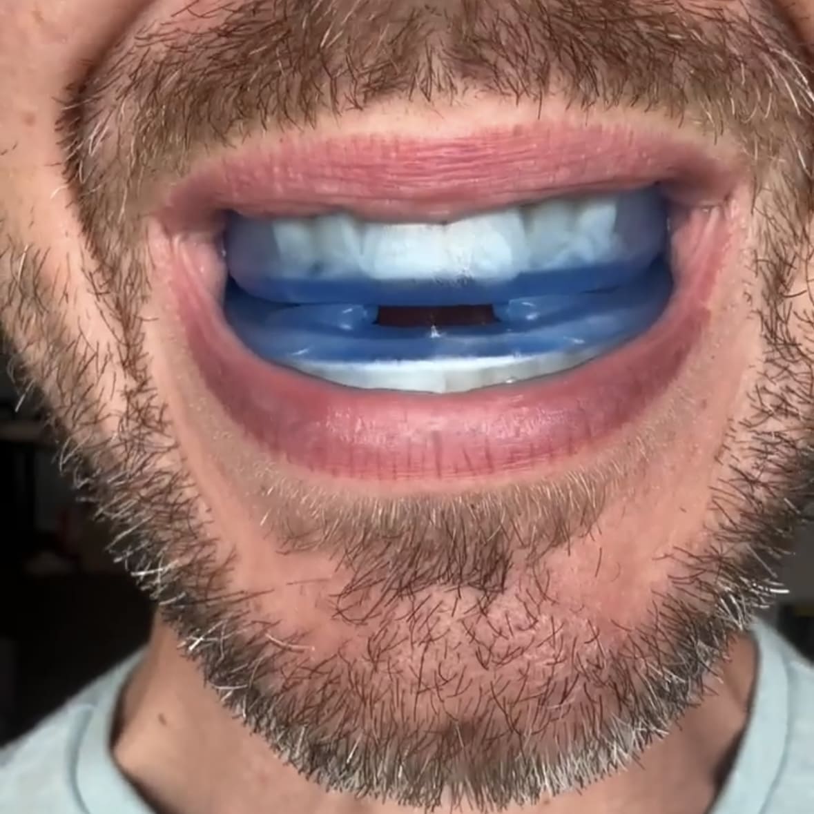 Honex® Pro Anti-Snoring Mouthpiece